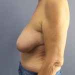 Mastopexy (Breast Lift) Before & After Patient #8377