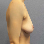 Breast Reduction Before & After Patient #7509