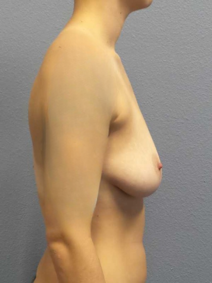 Breast Reduction Before & After Patient #7509