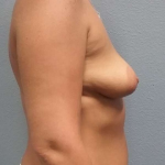 Asymmetric (Uneven) Breasts Before & After Patient #6865