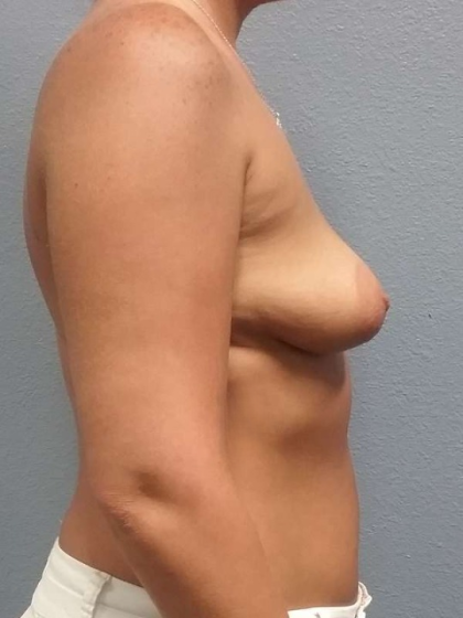 Asymmetric (Uneven) Breasts Before & After Patient #6865