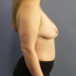 Breast Lift with Implant (Augmentation Mastopexy) Before & After Patient #4427