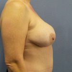 Breast Lift with Implant (Augmentation Mastopexy) Before & After Patient #4220