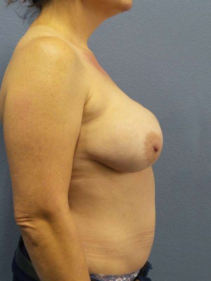 Breast Lift with Implant (Augmentation Mastopexy) Before & After Patient #4220