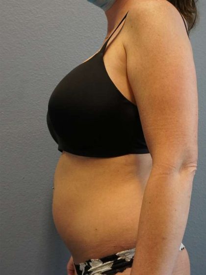 Liposuction Female Before & After Patient #8101