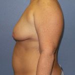 Breast Lift with Implant (Augmentation Mastopexy) Before & After Patient #4013