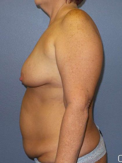 Breast Lift with Implant (Augmentation Mastopexy) Before & After Patient #4013