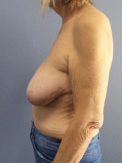 Breast Reduction Before & After Patient #7487
