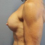 Breast Augmentation Revision (Breast Enlargement Repair) Before & After Patient #7291