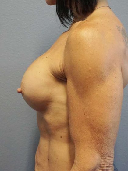 Breast Augmentation Revision (Breast Enlargement Repair) Before & After Patient #7291