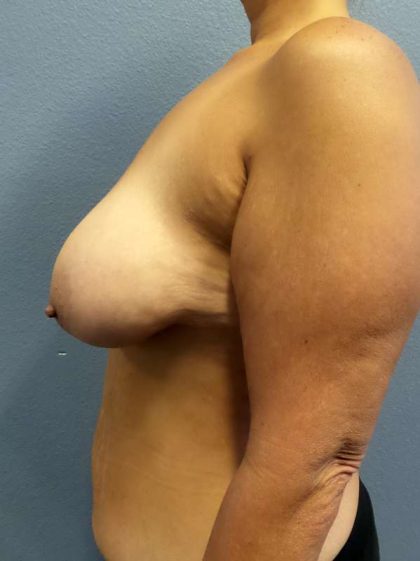 Breast Lift with Implant (Augmentation Mastopexy) Before & After Patient #4066