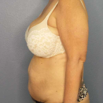 High BMI (Larger Patients) Surgery Before & After Patient #10438
