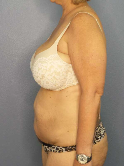 High BMI (Larger Patients) Surgery Before & After Patient #10438