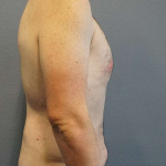 Male Liposuction Before & After Patient #3808