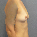 Breast Augmentation Before & After Patient #5433