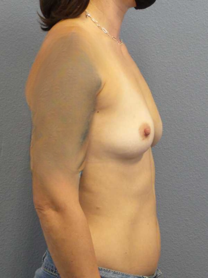 Breast Augmentation Before & After Patient #5433