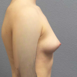 Breast Augmentation Before & After Patient #5296