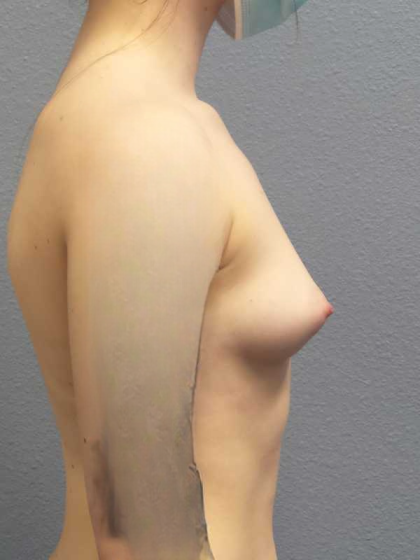 Breast Augmentation Before & After Patient #5296
