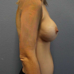 Breast Augmentation Revision (Breast Enlargement Repair) Before & After Patient #7379