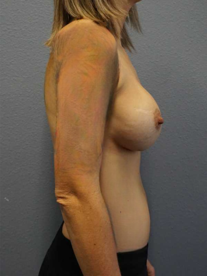 Breast Augmentation Revision (Breast Enlargement Repair) Before & After Patient #7379