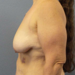 Breast Lift with Implant (Augmentation Mastopexy) Before & After Patient #4601
