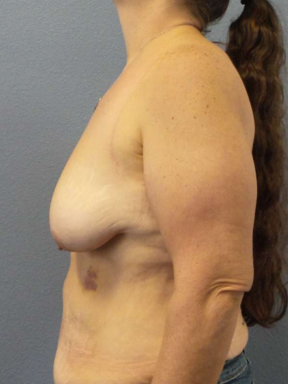 Breast Lift with Implant (Augmentation Mastopexy) Before & After Patient #4601