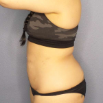 Liposuction Female Before & After Patient #8035