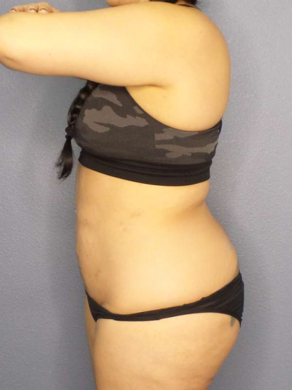 Liposuction Female Before & After Patient #8035