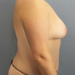 Breast Lift with Implant (Augmentation Mastopexy) Before & After Patient #4509