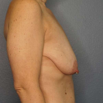 Breast Lift with Implant (Augmentation Mastopexy) Before & After Patient #3989