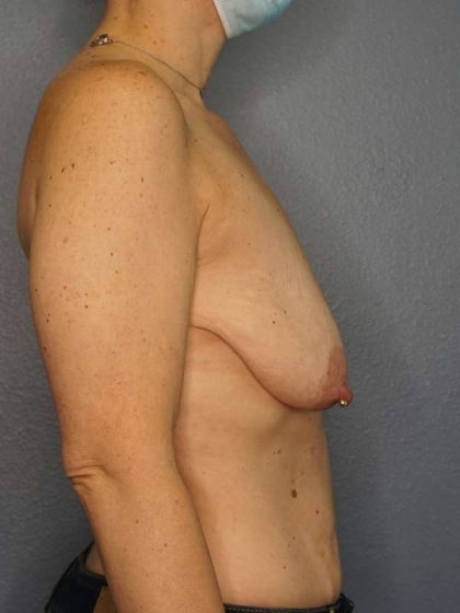 Breast Lift with Implant (Augmentation Mastopexy) Before & After Patient #3989