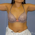 Liposuction Female Before & After Patient #7951