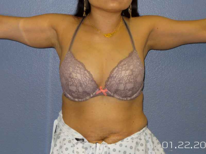 Liposuction Female Before & After Patient #7951
