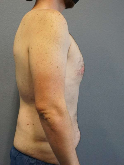 Male Liposuction Before & After Patient #3808