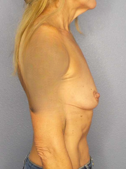 Breast Augmentation Before & After Patient #7056