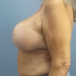 Breast Lift with Implant (Augmentation Mastopexy) Before & After Patient #3967