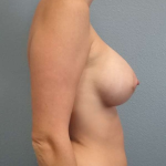 Breast Augmentation Before & After Patient #6601