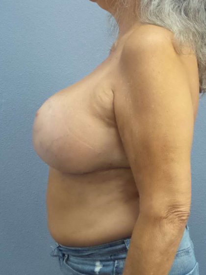 Breast Lift with Implant (Augmentation Mastopexy) Before & After Patient #3967