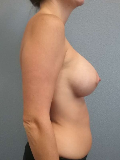 Breast Augmentation Before & After Patient #6601