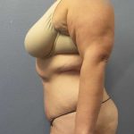 High BMI (Larger Patients) Surgery Before & After Patient #10393