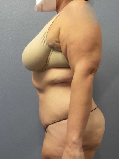 High BMI (Larger Patients) Surgery Before & After Patient #10393