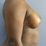 Breast Augmentation Before & After Patient #11436
