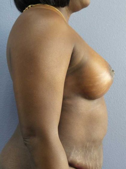 Breast Augmentation Before & After Patient #11436