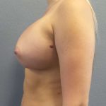 Breast Augmentation Before & After Patient #6919
