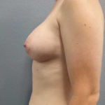 Breast Augmentation Before & After Patient #5706