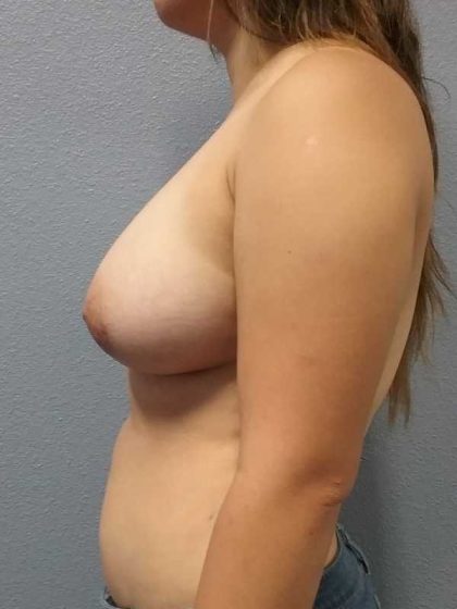 Breast Augmentation Before & After Patient #6826