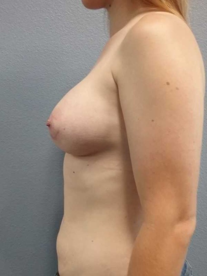 Breast Augmentation Before & After Patient #5706