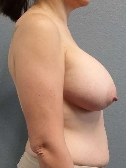 Breast Augmentation Before & After Patient #6749