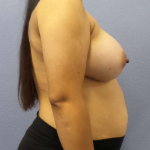 Breast Augmentation Before & After Patient #5114