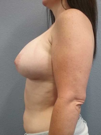 Breast Augmentation Before & After Patient #5729